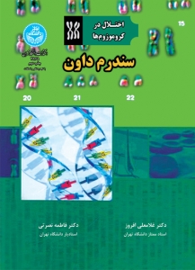 اختلال در کروموزوم ها سندرون داون 